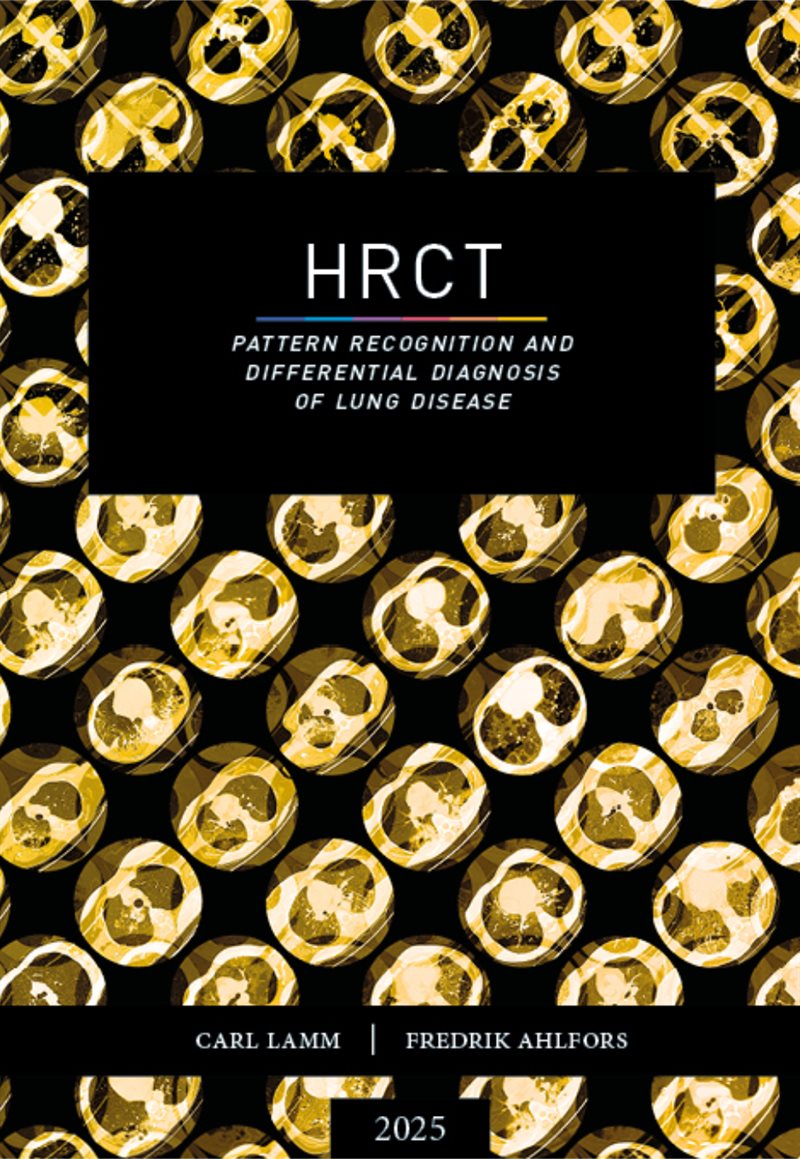 HRCT - Pattern recognition and differential diagnosis of lung disease